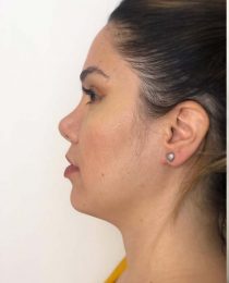 Diário da rinoplastia: a cirurgia plástica de nariz, um ano e meio depois